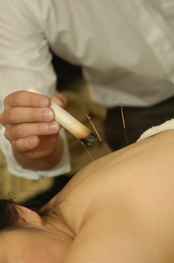 back acupuncture at maitland wellness centre