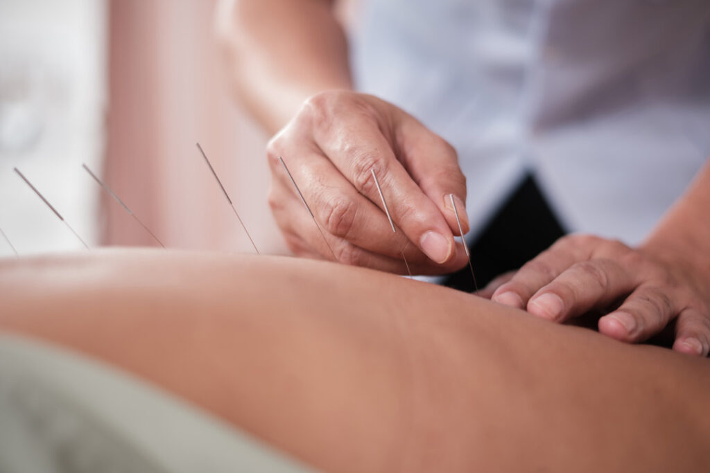 Asian physiotherapist treats patient's back muscle pain relief by acupuncture hand procedure