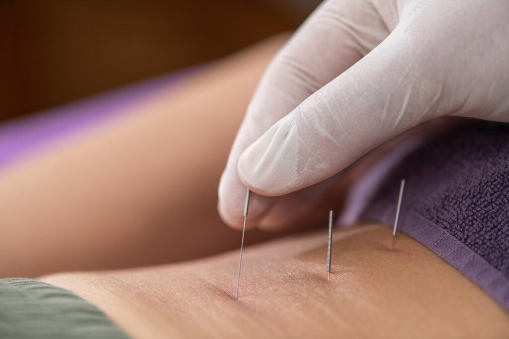 Physical therapist performing dry needling on a patient's lower back to relieve muscle pain, promoting healing through targeted trigger point therapy